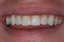 1 veneers after