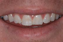 1 veneers before