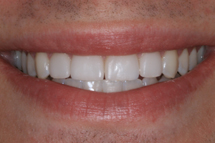 4 whitening after