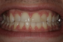 4 whitening before