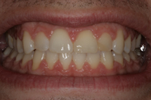 4 whitening before